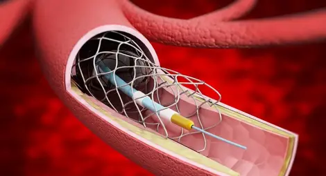 Стентът - надежда или кошмар е това? Как животоспасяващото средство се превърна в страшна /и мръсна/ дума