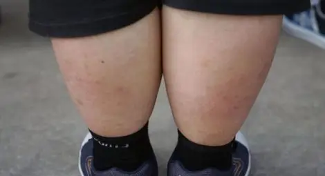 30,2% от учениците до 19 години страдат от наднормено тегло