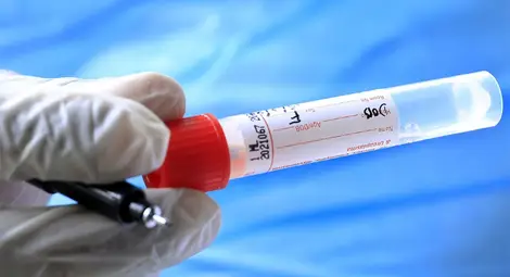 123 са новите случаи на Covid-19 в Русе и областта, осем от инфектираните са ученици