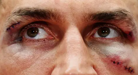 Кличко: Още не съм на себе си. Страдам