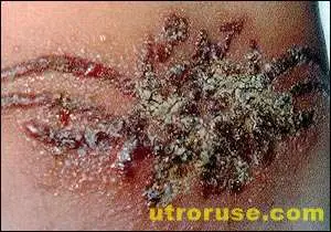 Временни татуировки, мокри кърпички и бабини рецепти водят до алергии