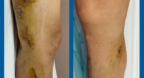 С минимален разрез кардиохирурзите на МЕДИКА безопасно вземат вена за коронарен байпас