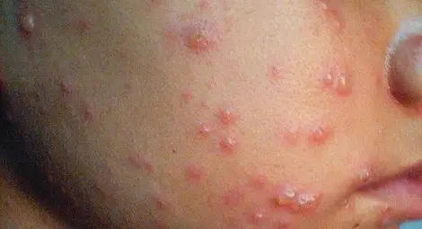 Варицела и скарлатина плъзнаха по забавачките