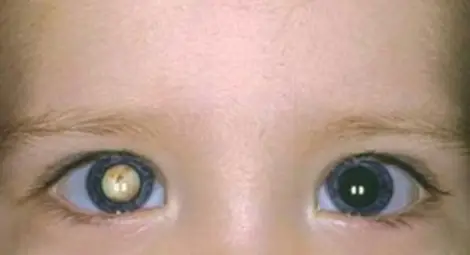 Научен пробив! Присадени стволови клетки върнаха зрението на деца с катаракта