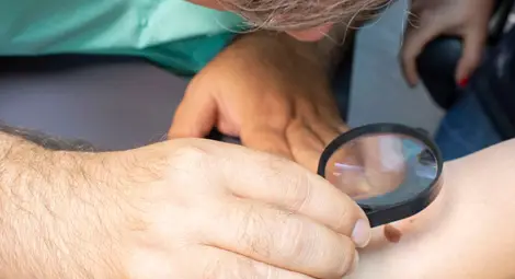 &bdquo;Медика&ldquo;: През последните години се увеличават кожните карциноми при по-млади хора, слънчевите изгаряния са опасни за някои видове бенки