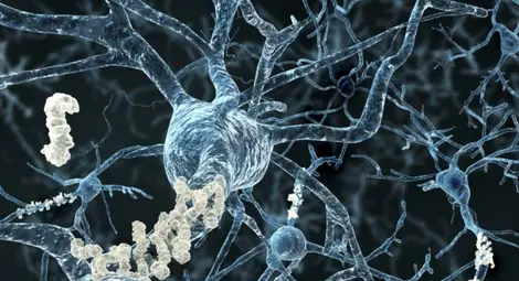 Учени: Открихме нов метод за лечение на болестта на Алцхаймер