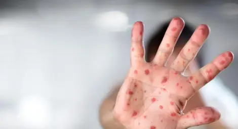 РЗИ-София: Нямаме извънредна ситуация с варицела и скарлатина РЗИ-София: Нямаме извънредна ситуация с варицела и скарлатина