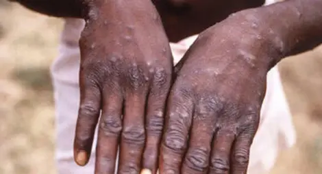 Общият брой на случаите на маймунска шарка в Гърция достигна 50 Общият брой на случаите на маймунска шарка в Гърция достигна 50