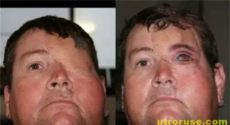 Татуираха око на ухапан от смъртоносен паяк Татуираха око на ухапан от смъртоносен паяк