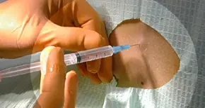 Мъж осъди анестезиолог заради неистови болки от 8 неуспешни опита за упойка