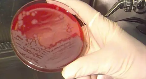 Мъж от Ясенково се е заразил с антракс от болно агне 