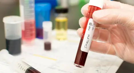 Дете от Пловдив е със съмнение за морбили Дете от Пловдив е със съмнение за морбили