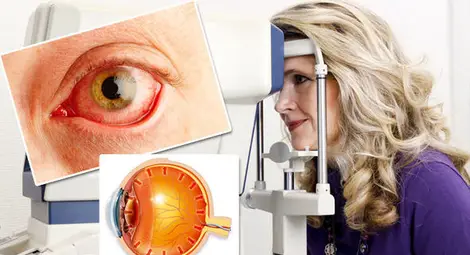 Мерят безплатно вътреочно налягане в болница &bdquo;Канев&ldquo;