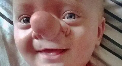 Истинският Буратино пребори мъчителна болест с усмивка /галерия/