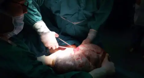 Д-р Георги Хубчев избави жена от 15-килограмов злокачествен тумор Д-р Георги Хубчев избави жена от 15-килограмов злокачествен тумор