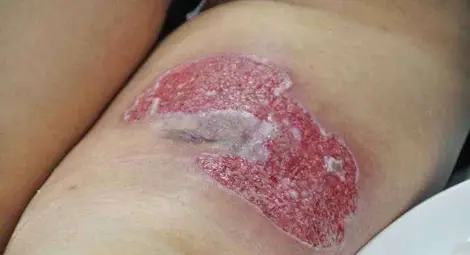 Ухапване от екзотично животно държи 40 дни бременна в болница