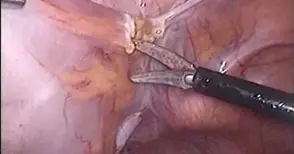 Първа безкръвна операция на тумор на дебелото черво в болницата