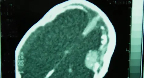 Д-р Огнян Игнатов: Спасяваме болни с тежки черепно-мозъчни травми