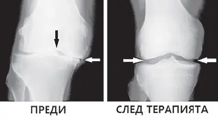 Край на болките в ставите!