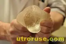 Страничен ефект - силиконките по-застрашени от рак на гърдата