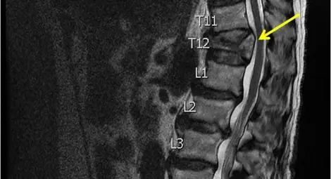 Изцяло новото Volvo XC90 въвежда за първи път в света решение, насочено към опасните катастрофи с внезапно напускане на пътното платно