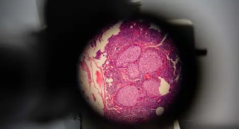 Учени откриха вирус, който се бори с рака