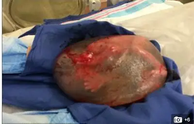 Бебе се роди в ембрионална торбичка