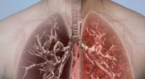 3 природни метода за пълно прочистване на белите дробове от катрани при пушене