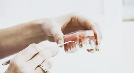 5 въпроса, които ще си зададете преди поставяне на дентални импланти