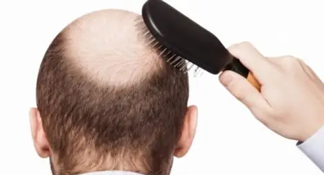 Генетици най-сетне разкриха тайната на оплешливяването