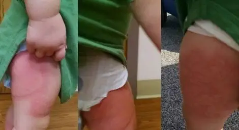 Дете пламна в мистериозен обрив! Родителите искат да предупредят какво е яло Дете пламна в мистериозен обрив! Родителите искат да предупредят какво е яло