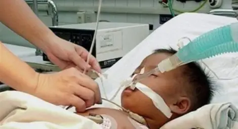 Рядък ентеровирус повали над 1300 деца в САЩ