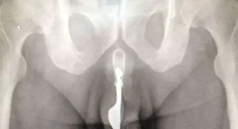 За идиотите почивен ден няма - лекари извадиха вилица от пениса на 70-годишен дядо