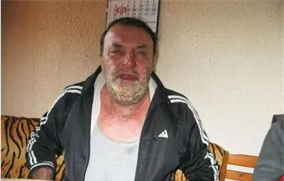 Самозапалилият се в ТЕЛК: Бюрокрацията ме докара до безизходица, срам ме е