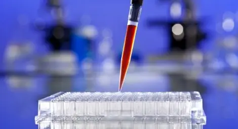 Предсказват появата на Алцхаймер чрез кръвен анализ