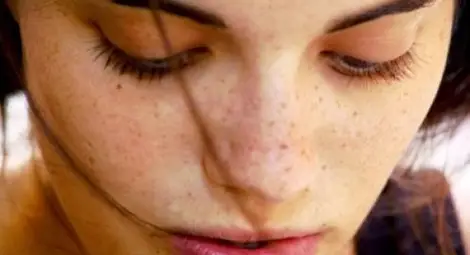 Как да се справим с луничките през лятото