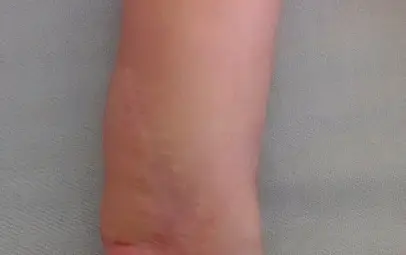 След операцията След операцията