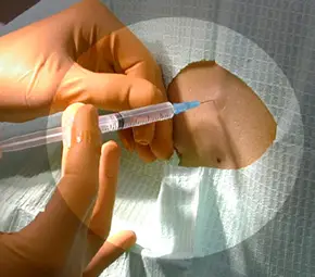 Мъж осъди анестезиолог заради неистови болки от 8 неуспешни опита за упойка Мъж осъди анестезиолог заради неистови болки от 8 неуспешни опита за упойка