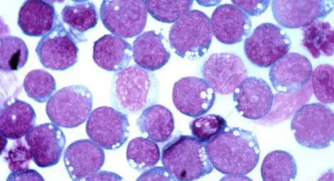 Открит е вирус, който причинява рак и безсмъртие на клетките Открит е вирус, който причинява рак и безсмъртие на клетките