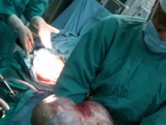 Туморът, изваден от корема на жената. Снимки: Красимир СТОЯНОВ и АГ-комплекс Туморът, изваден от корема на жената. Снимки: Красимир СТОЯНОВ и АГ-комплекс