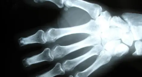 Чудили ли сте се какво се случва, когато изпукате кокалчетата на ръцете си?