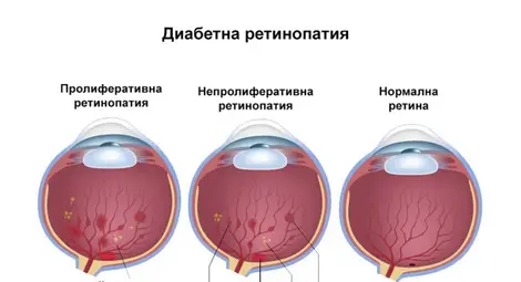 Д-р Магдалена Младенова: Нелекуваната диабетна ретинопатия води до прогресивно намаление на зрението Д-р Магдалена Младенова: Нелекуваната диабетна ретинопатия води до прогресивно намаление на зрението