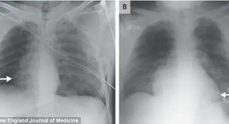 Сърцето на моторист мина вдясно след катастрофа