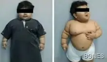 Двегодишно дете тежи 33 кг.