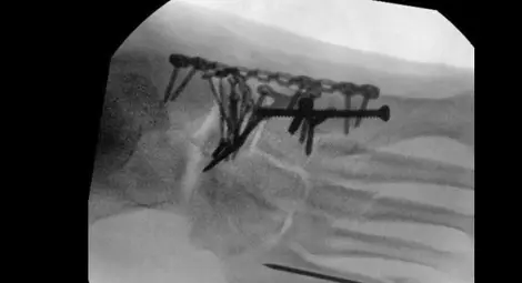 &bdquo;Сглобен&ldquo; отново: Моторист с 18 счупвания при катастрофа оцеля след 8 операции в &bdquo;Канев&ldquo;