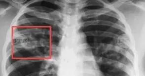 До 27 март в София ще има безплатни консултации за туберкулоза