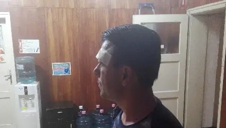 Лявата вежда на Али Али е спукана от нанесен удар от мъж от Шумен на Дунав мост.                                            Снимка: Авторът