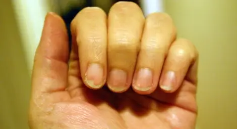 Мръсните нокти причиняват до 25% от заболяванията