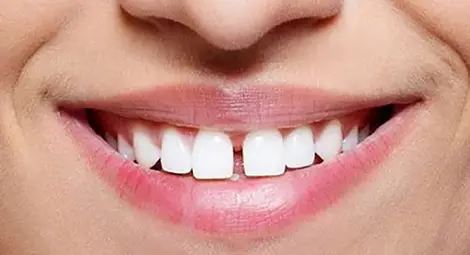Три решения за премахване на разстоянието между зъбите
