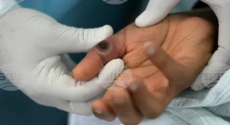 Специалисти изследват генетични мутации на маймунската шарка